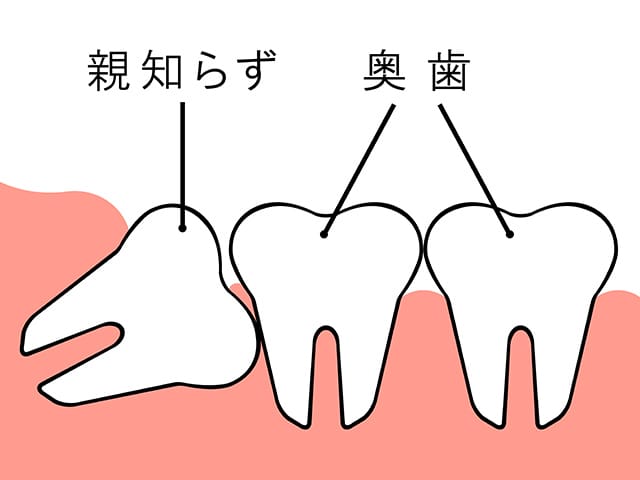 水平埋伏智歯